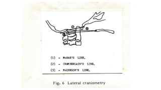 • McRae's line (1953) defines the opening of the foramen
magnum.
 