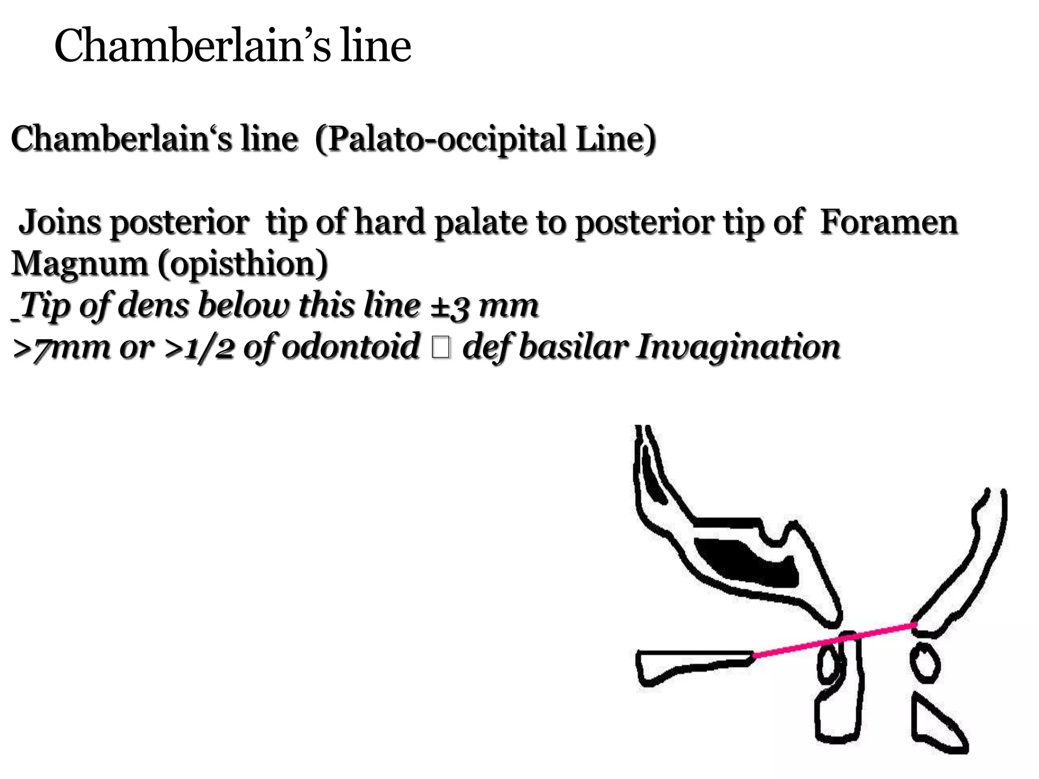 Chamberlain’s line
Chamberlain‘s line (Palato-occipital Line)
Joins posterior tip of hard palate to posterior tip of Foramen
Magnum (opisthion)
Tip of dens below this line ±3 mm
>7mm or >1/2 of odontoid def basilar Invagination
 