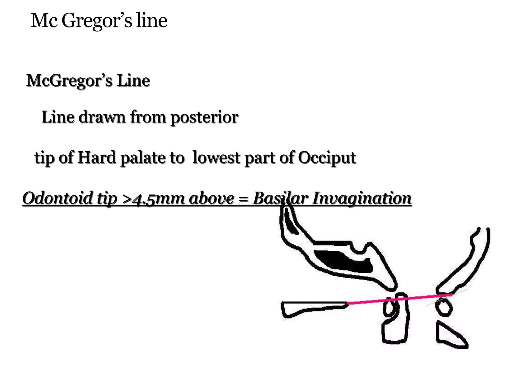 Mc Gregor’s line
McGregor’s Line
Line drawn from posterior
tip of Hard palate to lowest part of Occiput
Odontoid tip >4.5mm above = Basilar Invagination
 
