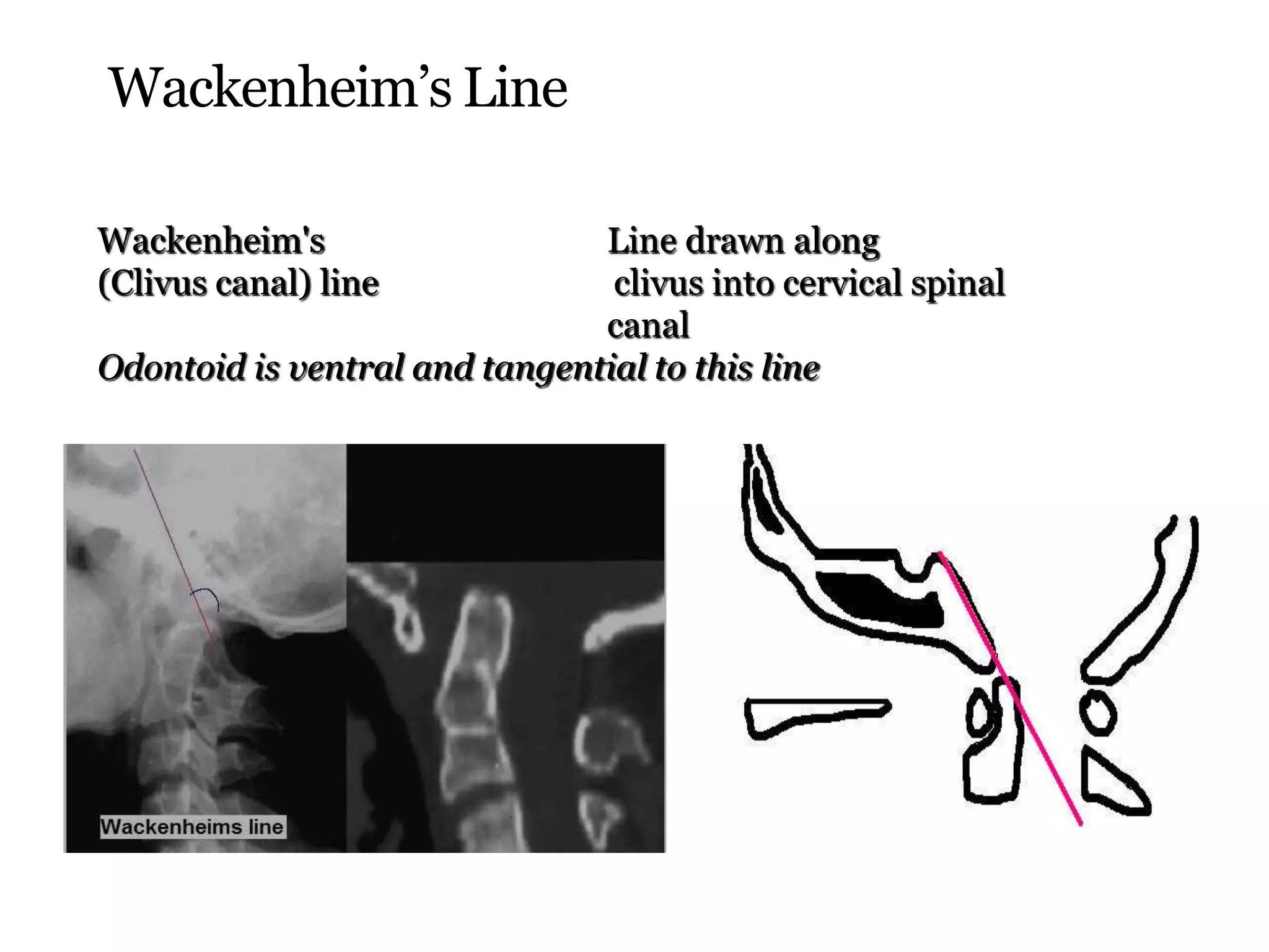 Wackenheim’s Line
Wackenheim's Line drawn along
(Clivus canal) line clivus into cervical spinal
canal
Odontoid is ventral and tangential to this line
 