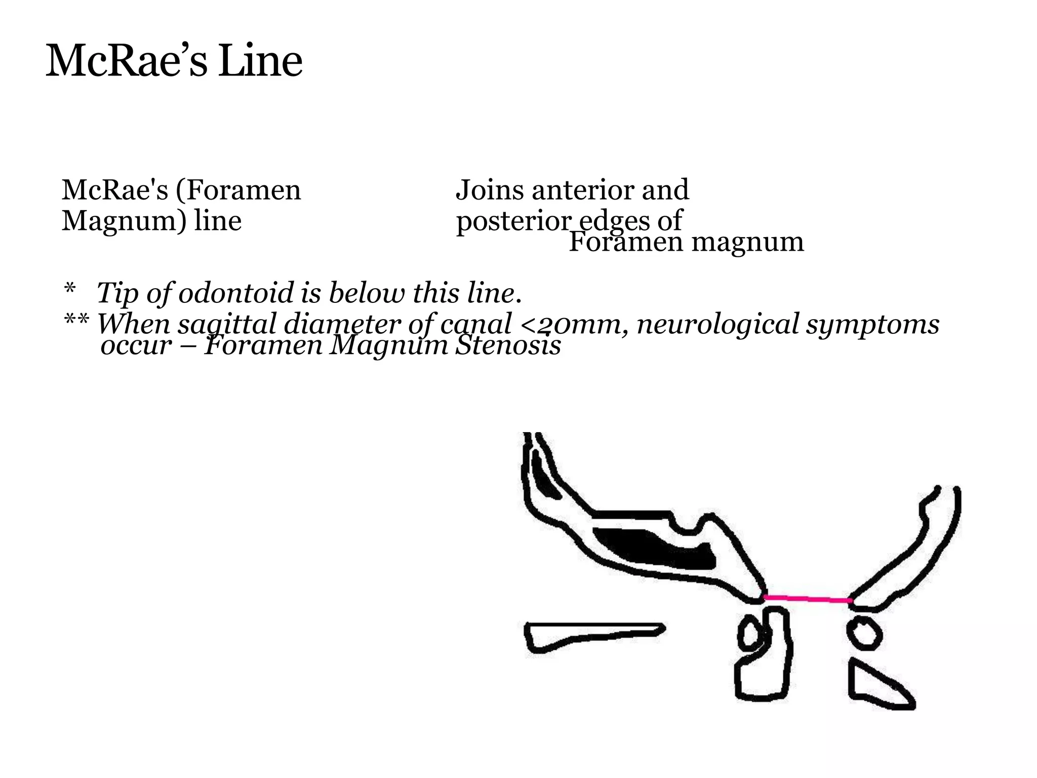 McRae’s Line
McRae's (Foramen Joins anterior and
Magnum) line posterior edges of
Foramen magnum
* Tip of odontoid is below this line.
** When sagittal diameter of canal <20mm, neurological symptoms
occur – Foramen Magnum Stenosis
 