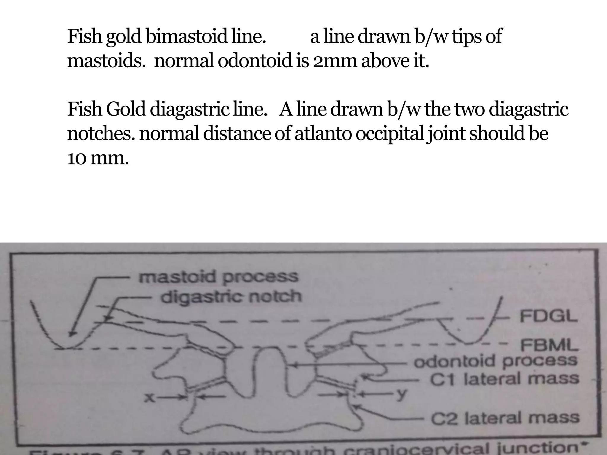 Fishgold bimastoidline. a line drawnb/w tipsof
mastoids. normalodontoidis2mmabove it.
FishGold diagastricline. A linedrawn b/w the two diagastric
notches.normal distanceof atlantooccipitaljointshouldbe
10 mm.
 