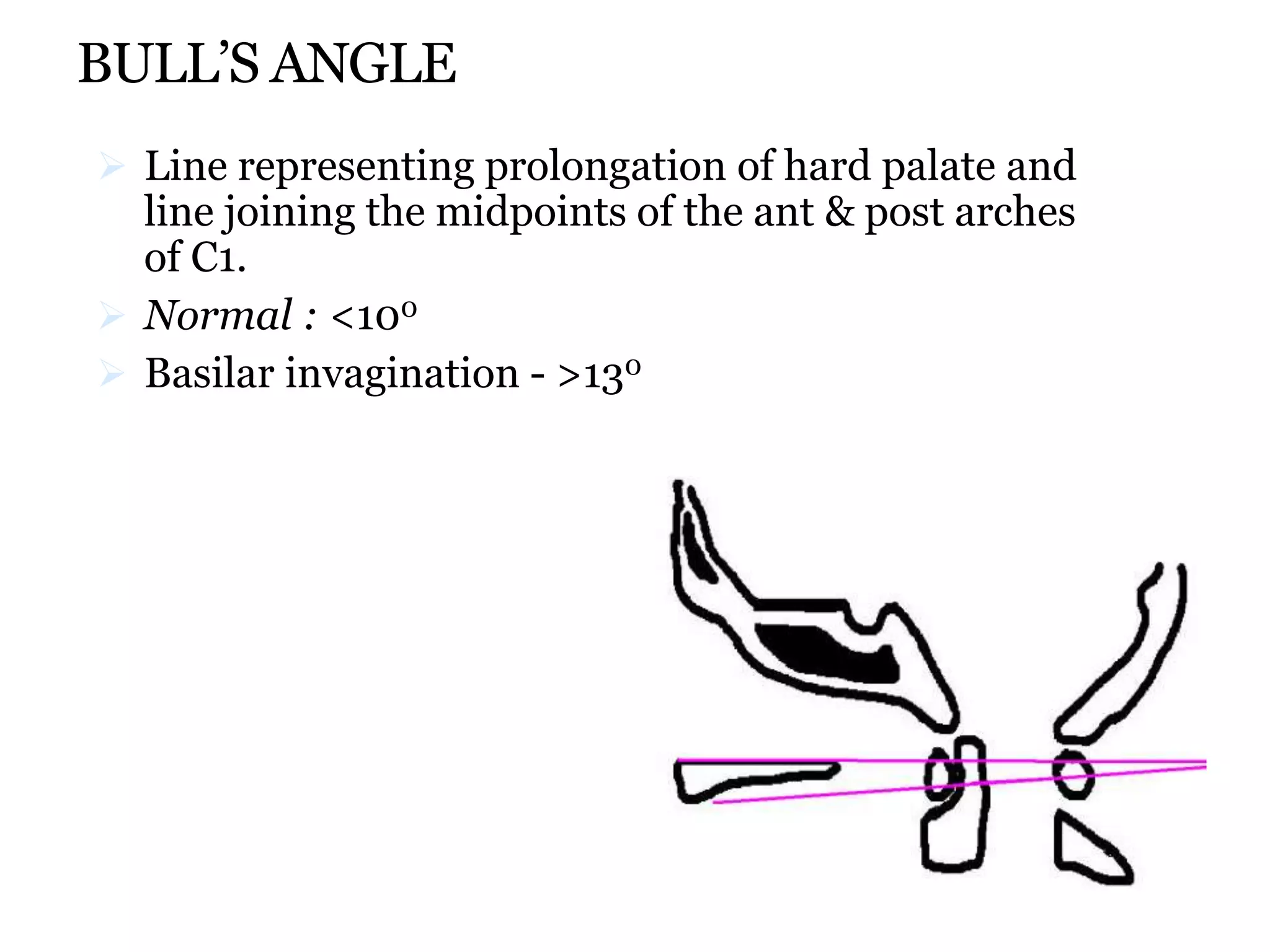 BULL’S ANGLE
 Line representing prolongation of hard palate and
line joining the midpoints of the ant & post arches
of C1.
 Normal : <100
 Basilar invagination - >130
 