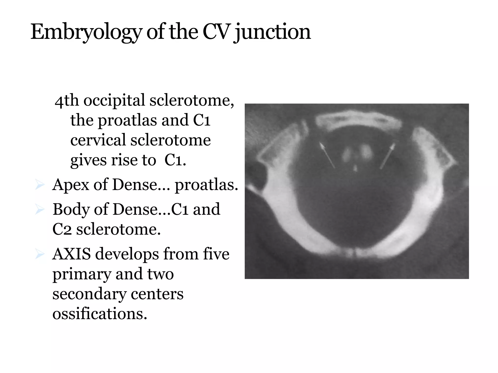 Embryology of the CV junction
4th occipital sclerotome,
the proatlas and C1
cervical sclerotome
gives rise to C1.
 Apex of Dense… proatlas.
 Body of Dense…C1 and
C2 sclerotome.
 AXIS develops from five
primary and two
secondary centers
ossifications.
 