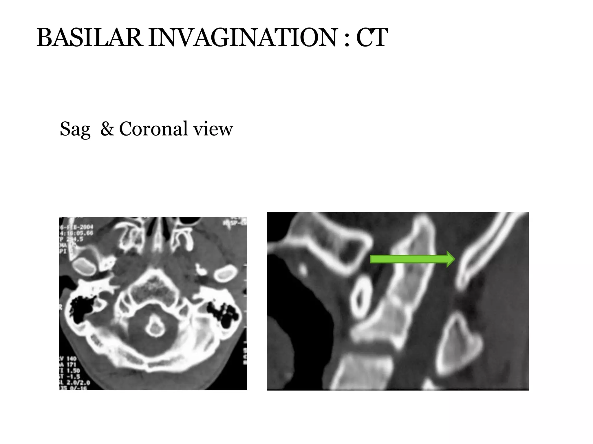 BASILAR INVAGINATION : CT
Sag & Coronal view
 