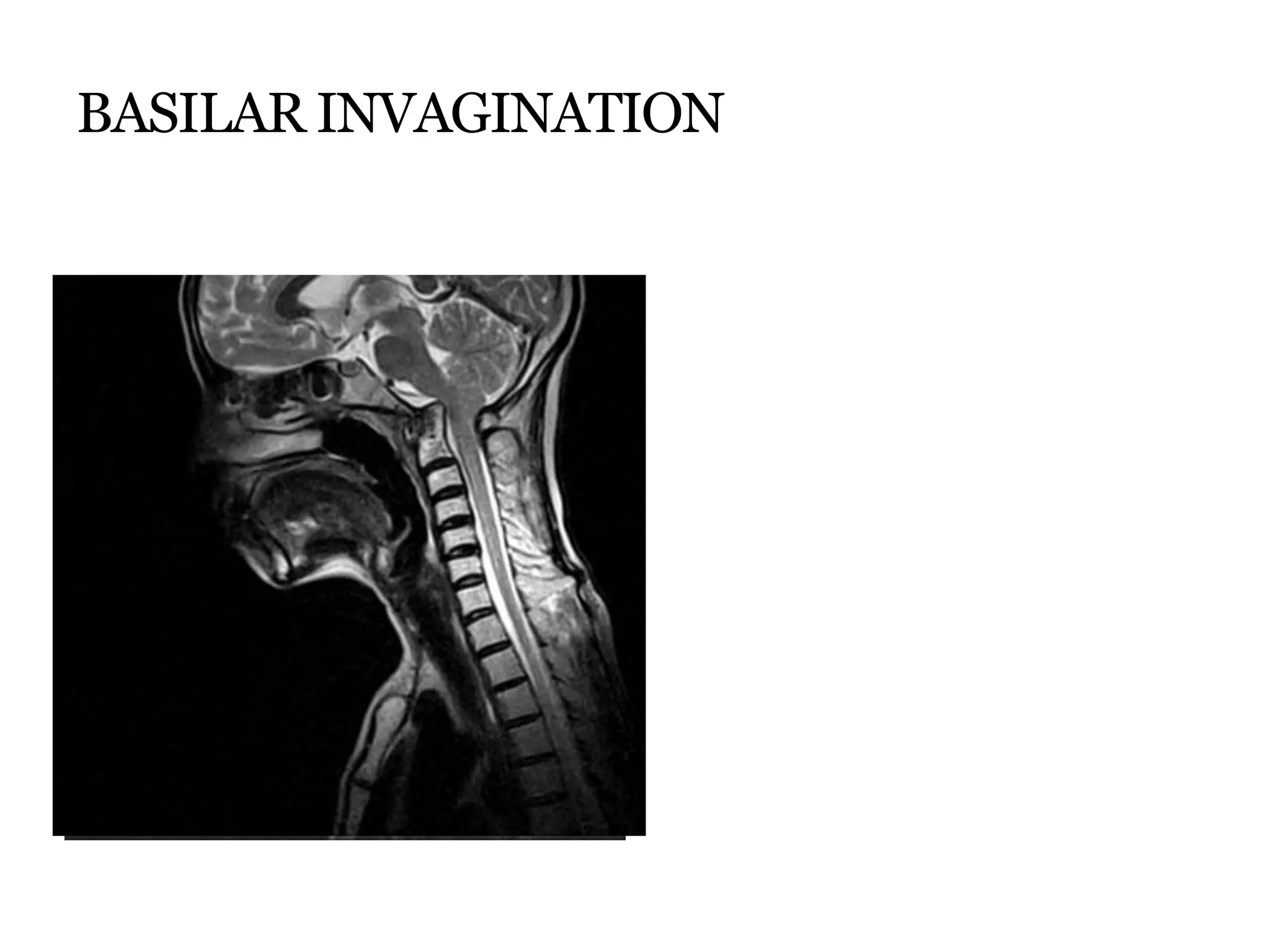 BASILAR INVAGINATION
 
