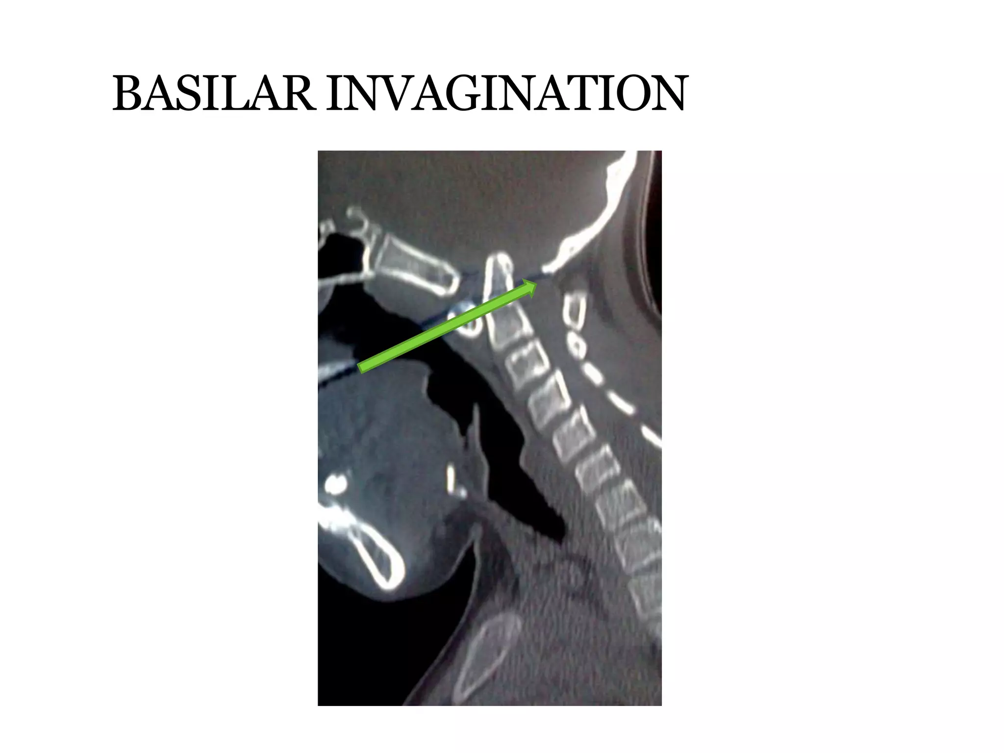 BASILAR INVAGINATION
 