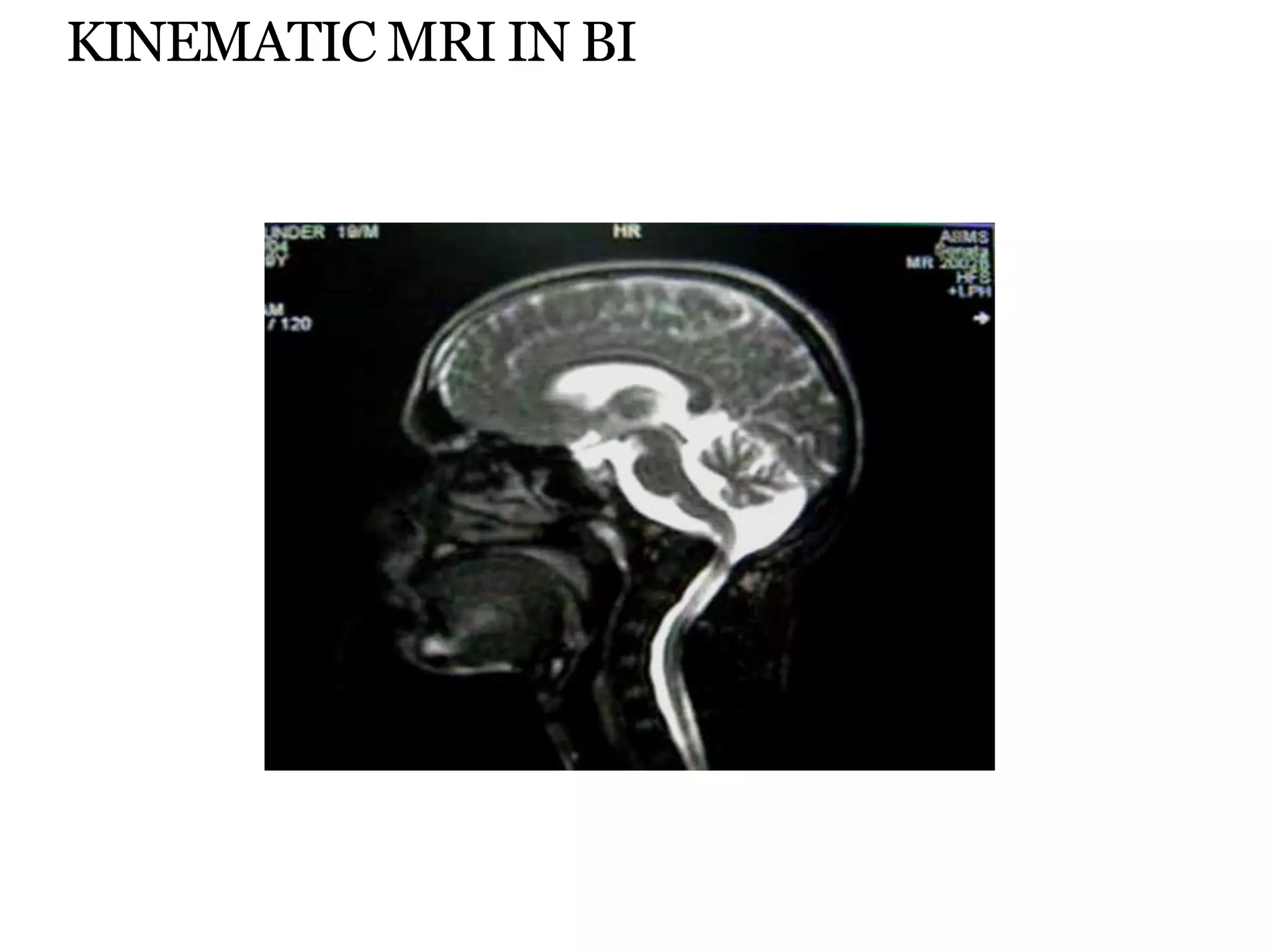 KINEMATIC MRI IN BI
 