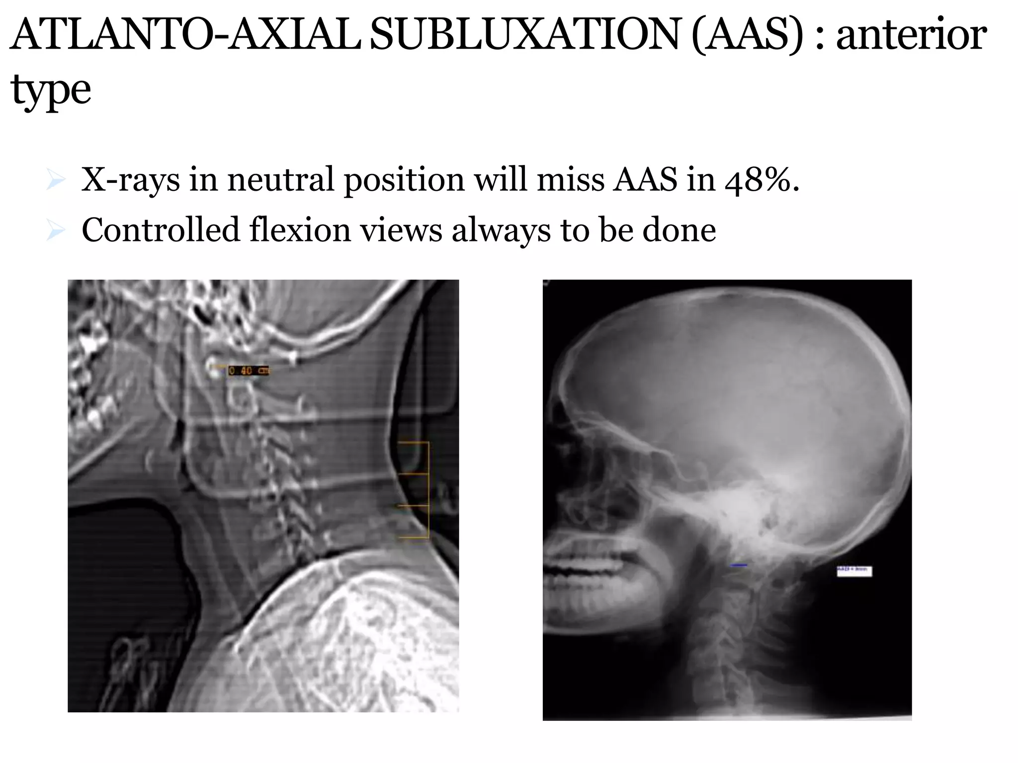 ATLANTO-AXIAL SUBLUXATION (AAS) : anterior
type
 X-rays in neutral position will miss AAS in 48%.
 Controlled flexion views always to be done
 