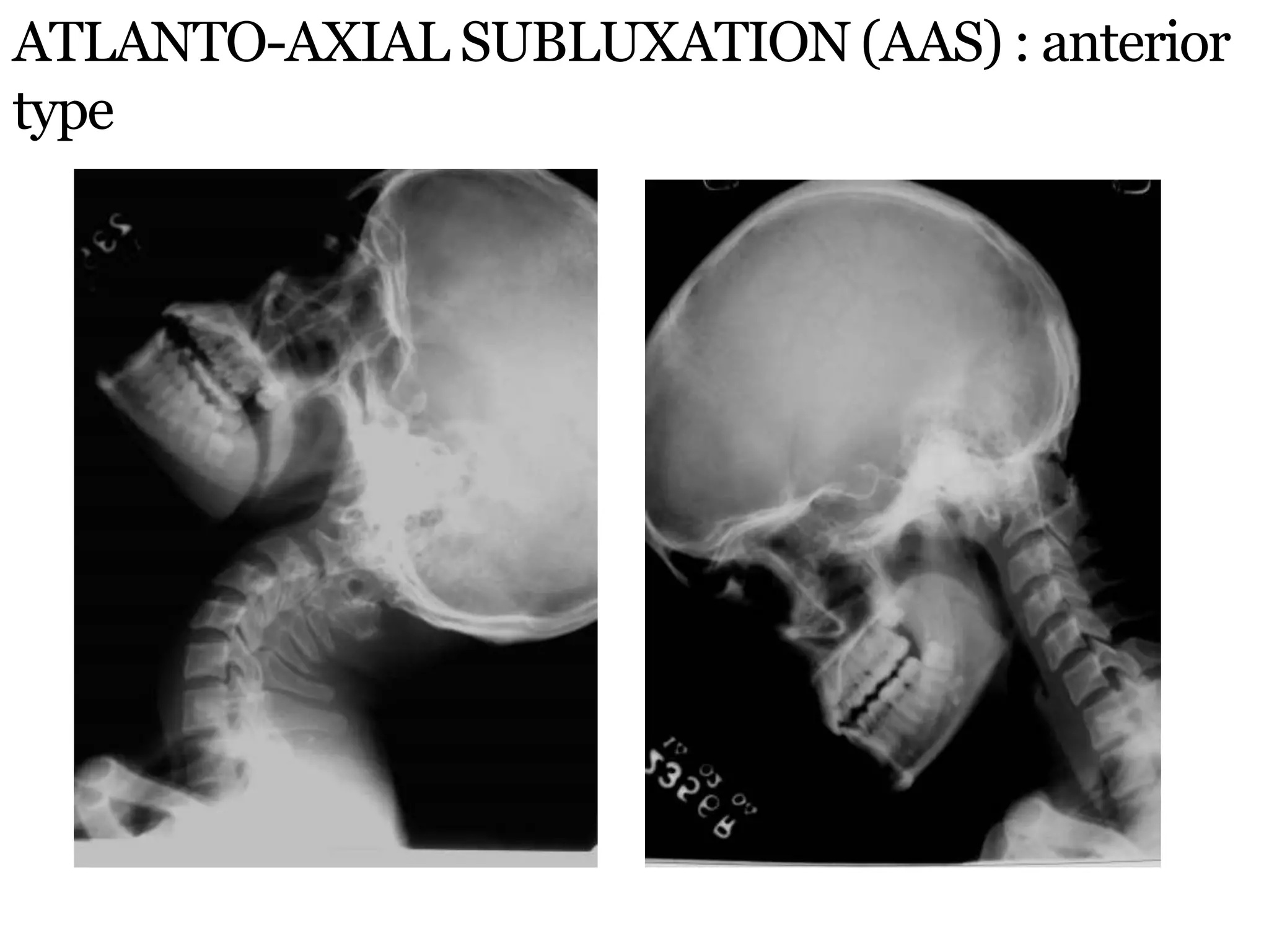 ATLANTO-AXIAL SUBLUXATION (AAS) : anterior
type
 
