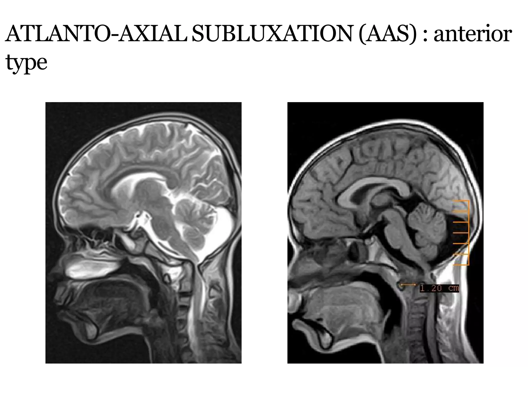 ATLANTO-AXIAL SUBLUXATION (AAS) : anterior
type
 