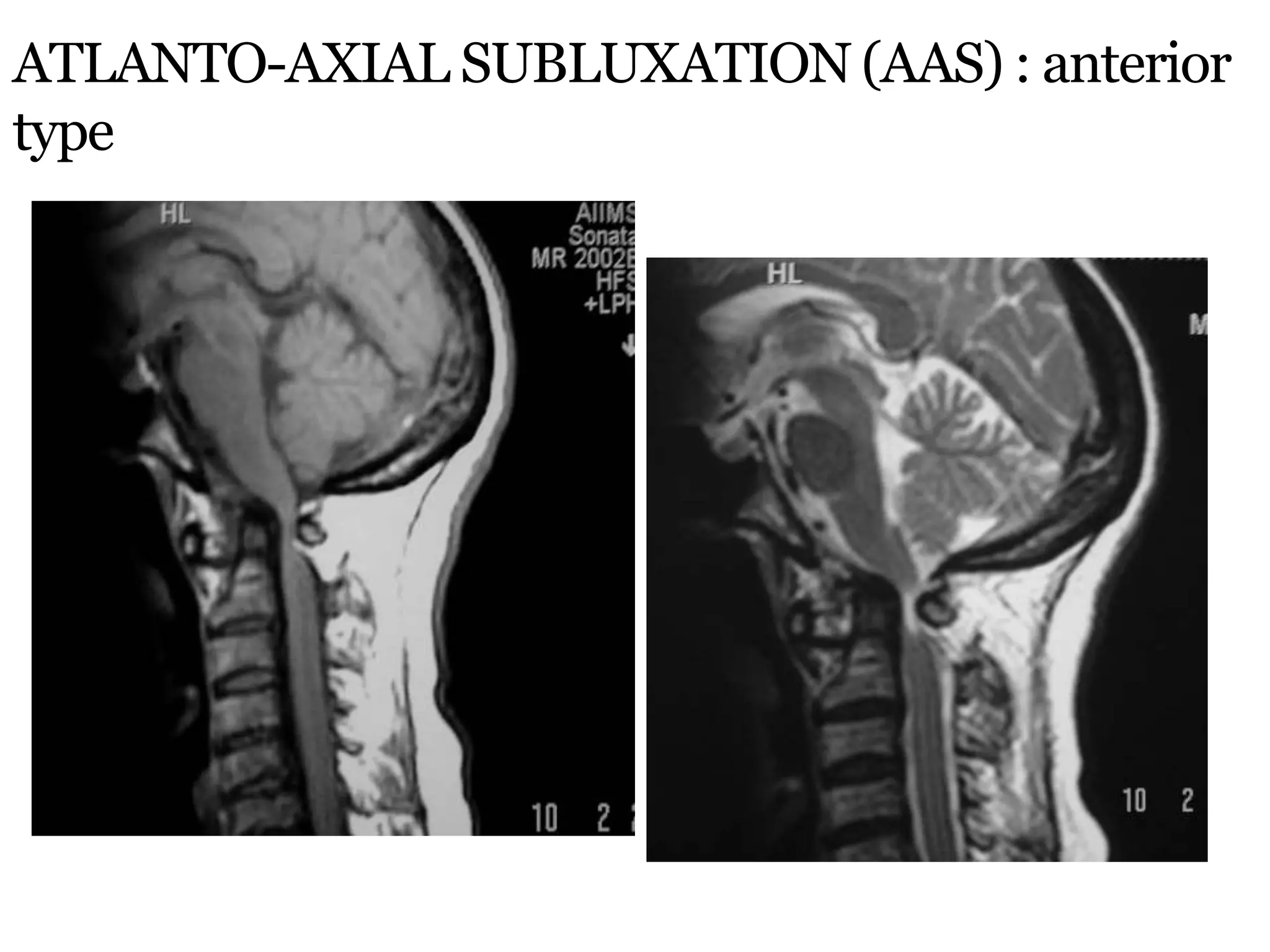 ATLANTO-AXIAL SUBLUXATION (AAS) : anterior
type
 
