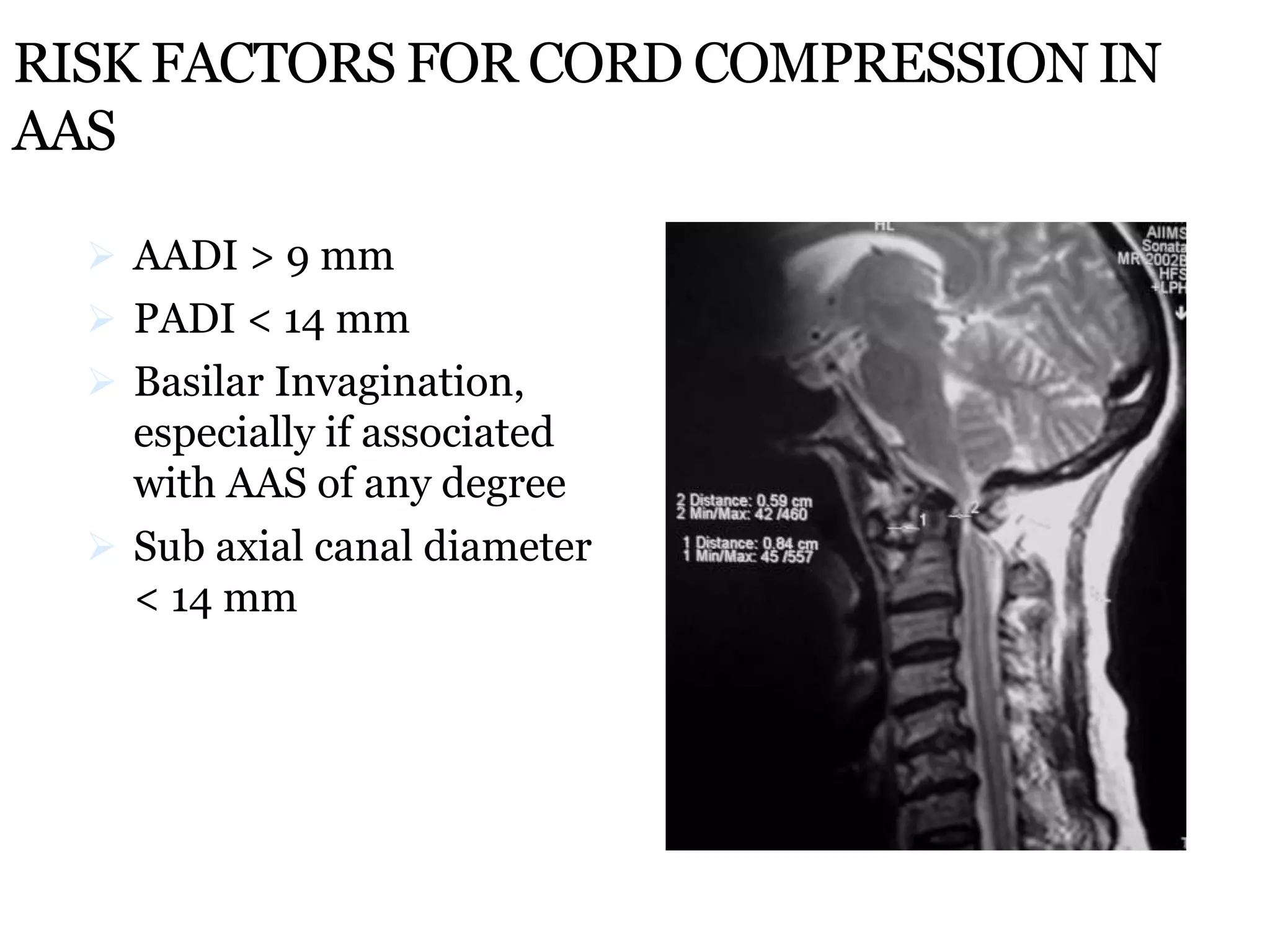 RISK FACTORS FOR CORD COMPRESSION IN
AAS
 AADI > 9 mm
 PADI < 14 mm
 Basilar Invagination,
especially if associated
with AAS of any degree
 Sub axial canal diameter
< 14 mm
 