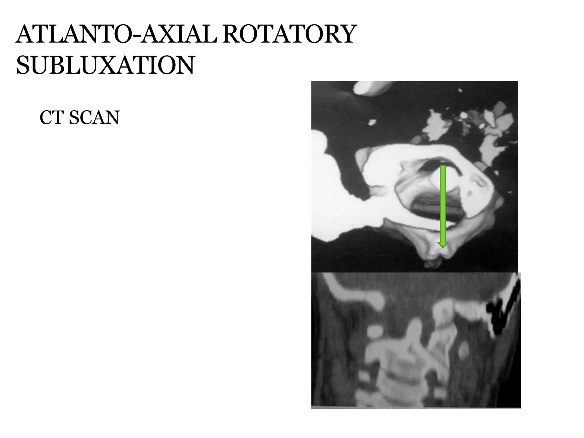 ATLANTO-AXIAL ROTATORY
SUBLUXATION
CT SCAN
 