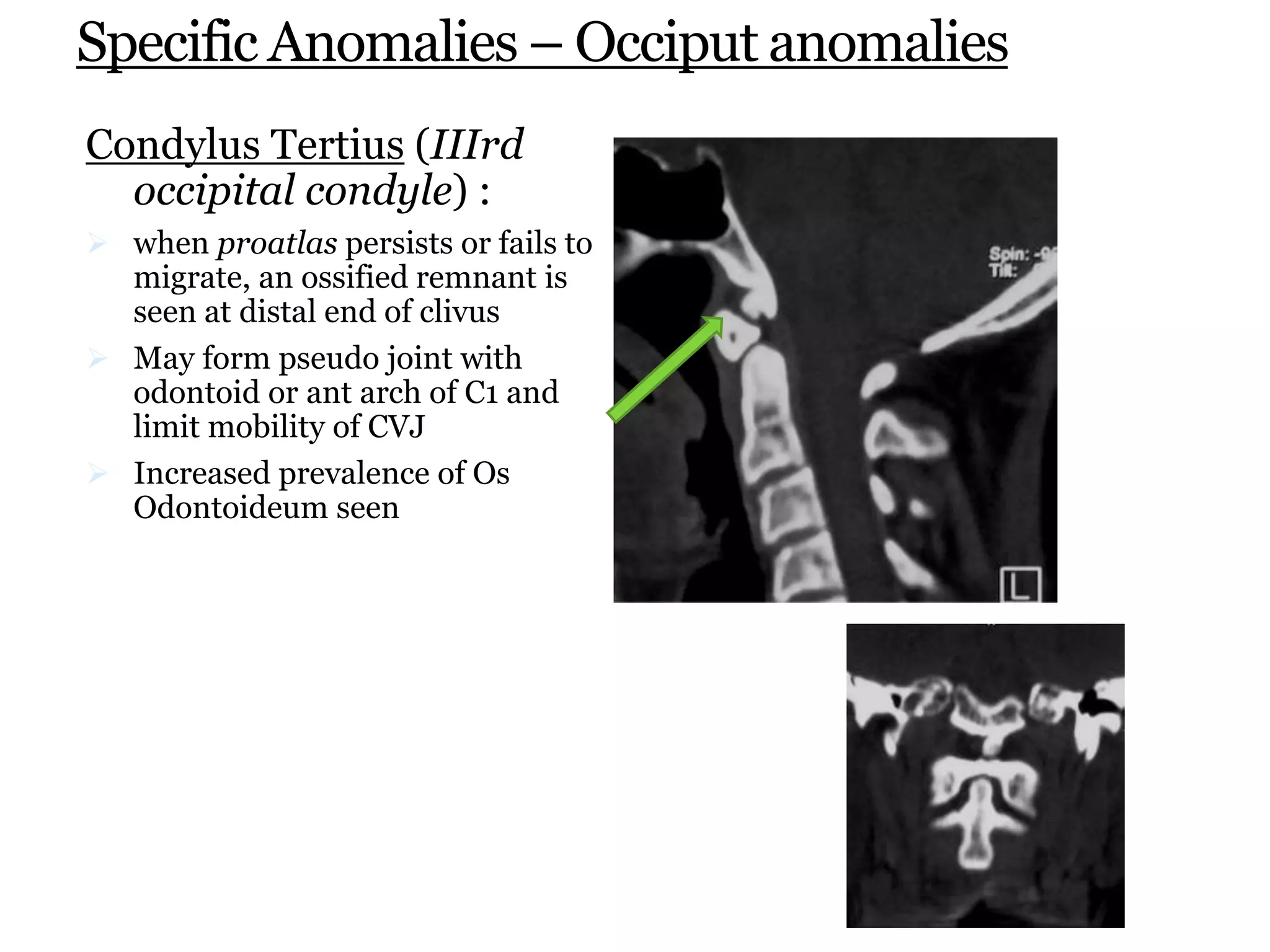Specific Anomalies – Occiput anomalies
Condylus Tertius (IIIrd
occipital condyle) :
 when proatlas persists or fails to
migrate, an ossified remnant is
seen at distal end of clivus
 May form pseudo joint with
odontoid or ant arch of C1 and
limit mobility of CVJ
 Increased prevalence of Os
Odontoideum seen
 
