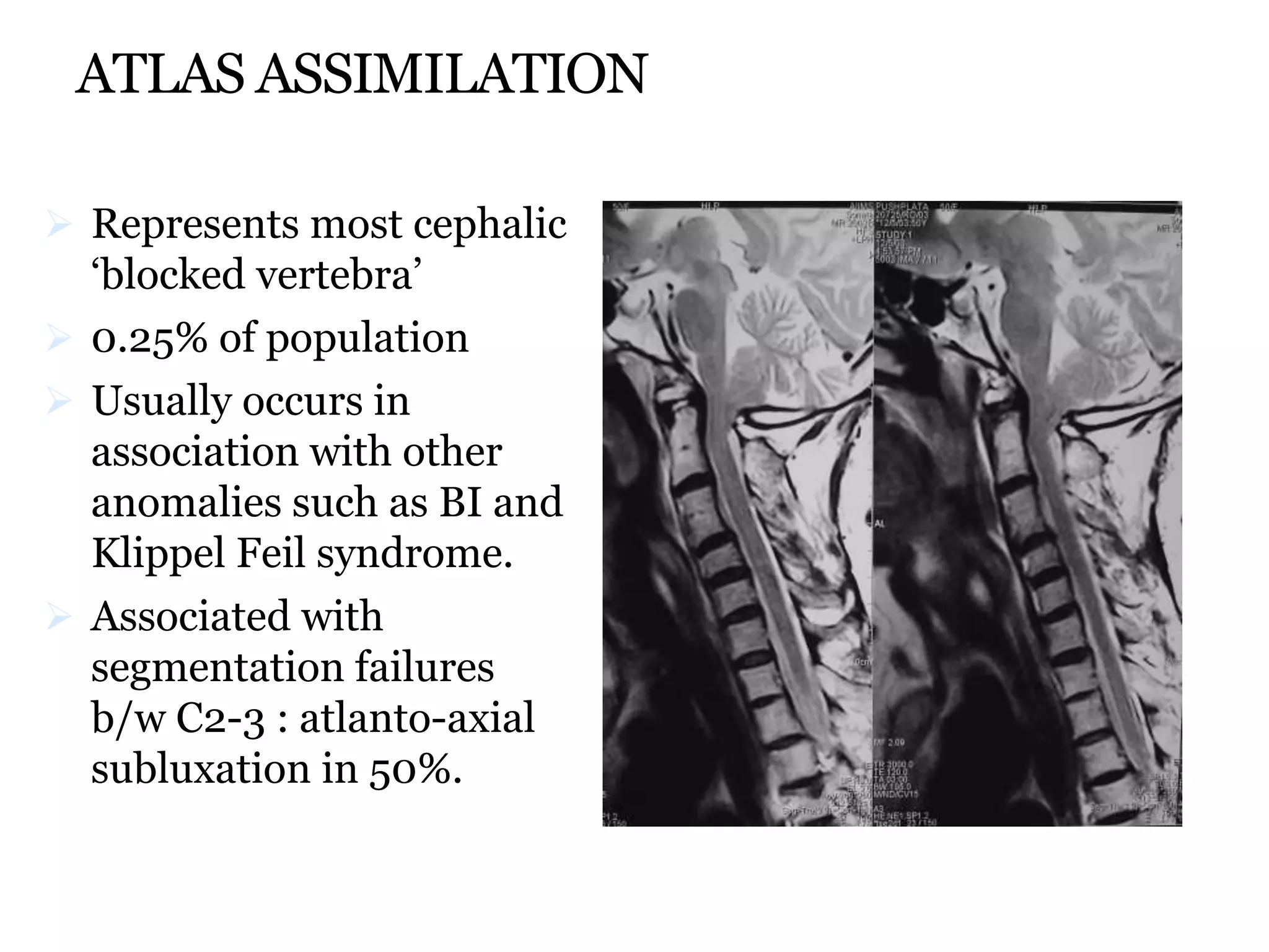 ATLAS ASSIMILATION
 Represents most cephalic
‘blocked vertebra’
 0.25% of population
 Usually occurs in
association with other
anomalies such as BI and
Klippel Feil syndrome.
 Associated with
segmentation failures
b/w C2-3 : atlanto-axial
subluxation in 50%.
 