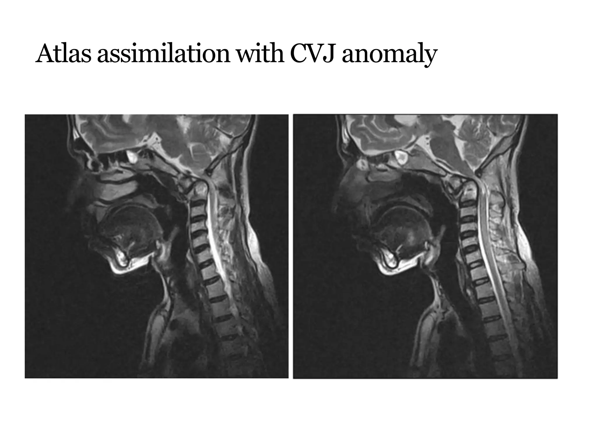 Atlas assimilation with CVJ anomaly
 