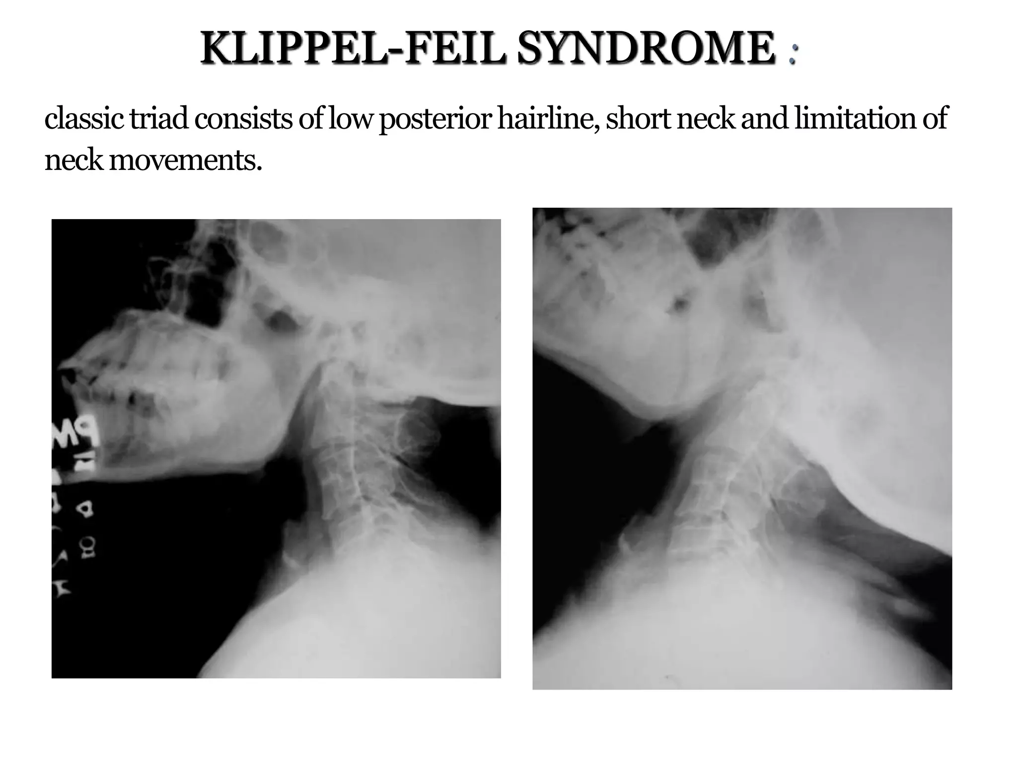 classictriadconsistsoflowposteriorhairline,shortneckand limitationof
neckmovements.
KLIPPEL-FEIL SYNDROME :
 