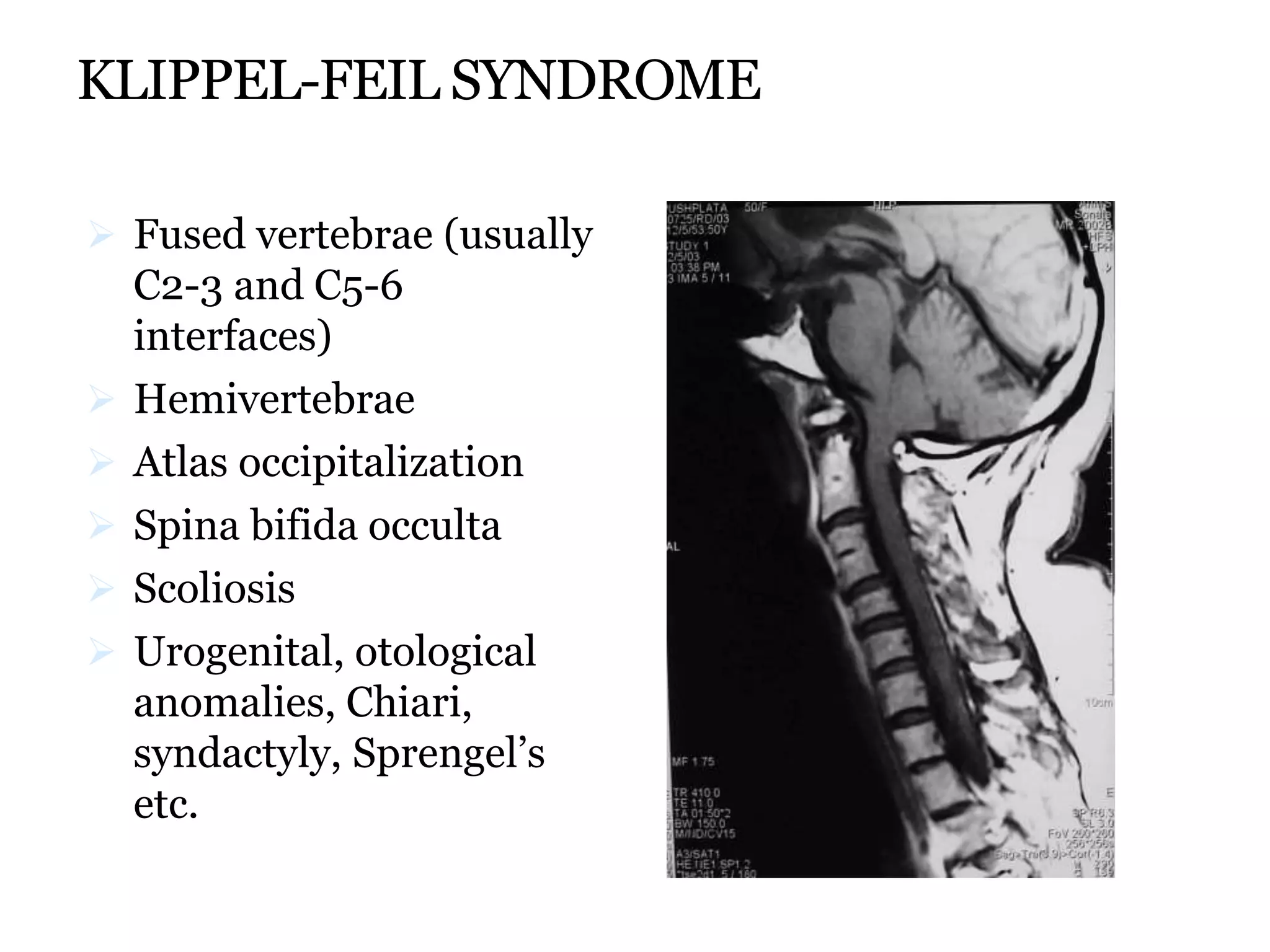 KLIPPEL-FEIL SYNDROME
 Fused vertebrae (usually
C2-3 and C5-6
interfaces)
 Hemivertebrae
 Atlas occipitalization
 Spina bifida occulta
 Scoliosis
 Urogenital, otological
anomalies, Chiari,
syndactyly, Sprengel’s
etc.
 
