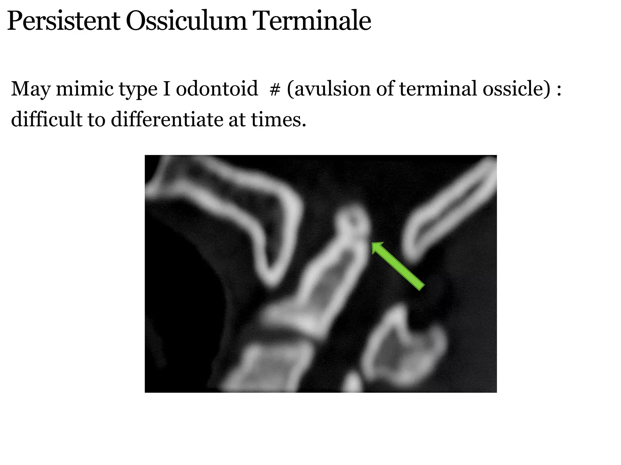 Persistent Ossiculum Terminale
May mimic type I odontoid # (avulsion of terminal ossicle) :
difficult to differentiate at times.
 