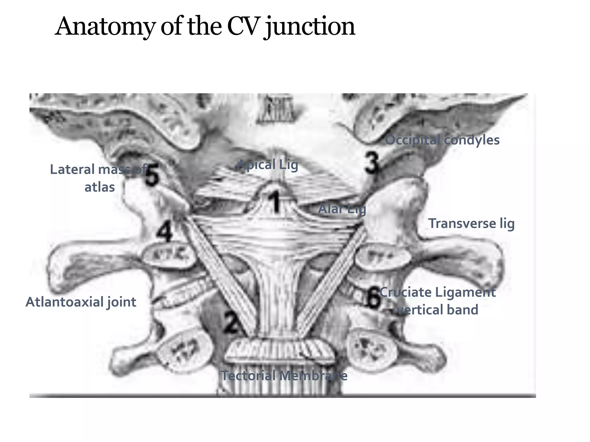 Anatomy of the CV junction
Occipital condyles
Atlantoaxial joint
Tectorial Membrane
Lateral mass of
atlas
Transverse lig
Cruciate Ligament
vertical band
Apical Lig
Alar Lig
 