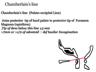 Chamberlain’s line
Chamberlain‘s line (Palato-occipital Line)
Joins posterior tip of hard palate to posterior tip of Foramen
Magnum (opisthion)
Tip of dens below this line ±3 mm
>7mm or >1/2 of odontoid def basilar Invagination
 