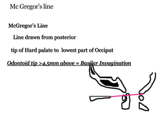 Mc Gregor’s line
McGregor’s Line
Line drawn from posterior
tip of Hard palate to lowest part of Occiput
Odontoid tip >4.5mm above = Basilar Invagination
 