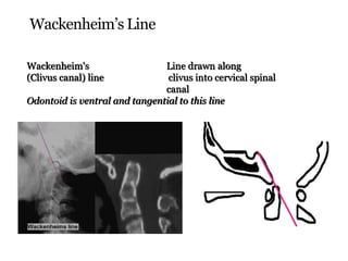 Wackenheim’s Line
Wackenheim's Line drawn along
(Clivus canal) line clivus into cervical spinal
canal
Odontoid is ventral and tangential to this line
 