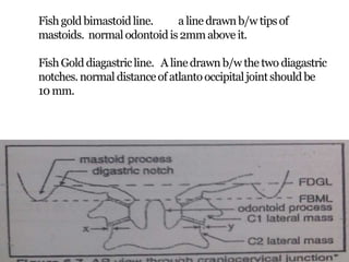 Fishgold bimastoidline. a line drawnb/w tipsof
mastoids. normalodontoidis2mmabove it.
FishGold diagastricline. A linedrawn b/w the two diagastric
notches.normal distanceof atlantooccipitaljointshouldbe
10 mm.
 