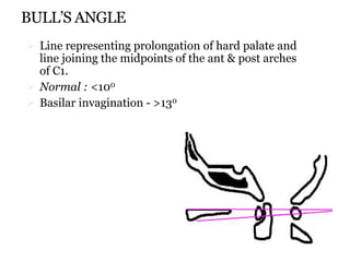BULL’S ANGLE
 Line representing prolongation of hard palate and
line joining the midpoints of the ant & post arches
of C1.
 Normal : <100
 Basilar invagination - >130
 