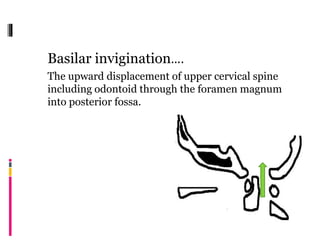 Basilar invigination….
The upward displacement of upper cervical spine
including odontoid through the foramen magnum
into posterior fossa.
 