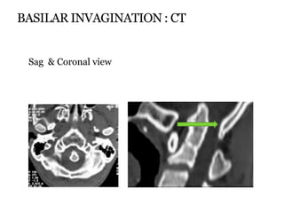 BASILAR INVAGINATION : CT
Sag & Coronal view
 