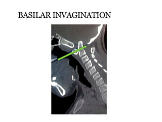 BASILAR INVAGINATION
 