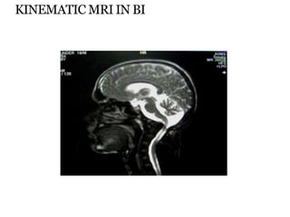 KINEMATIC MRI IN BI
 