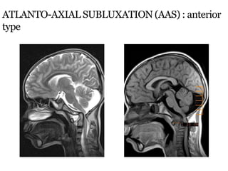 ATLANTO-AXIAL SUBLUXATION (AAS) : anterior
type
 