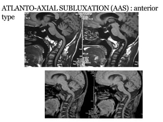 ATLANTO-AXIAL SUBLUXATION (AAS) : anterior
type
 