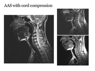 AAS with cord compression
 