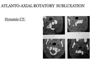ATLANTO-AXIAL ROTATORY SUBLUXATION
Dynamic CT:
 