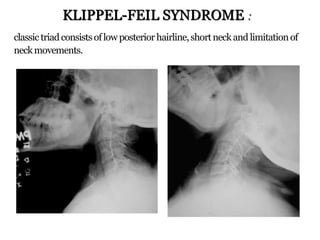 classictriadconsistsoflowposteriorhairline,shortneckand limitationof
neckmovements.
KLIPPEL-FEIL SYNDROME :
 