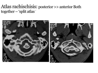 Atlas rachischisis: posterior >> anterior Both
together – ‘split atlas’
 