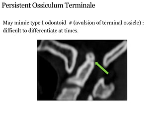 Persistent Ossiculum Terminale
May mimic type I odontoid # (avulsion of terminal ossicle) :
difficult to differentiate at times.
 