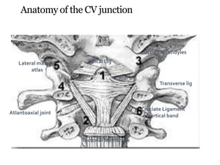 Anatomy of the CV junction
Occipital condyles
Atlantoaxial joint
Tectorial Membrane
Lateral mass of
atlas
Transverse lig
Cruciate Ligament
vertical band
Apical Lig
Alar Lig
 