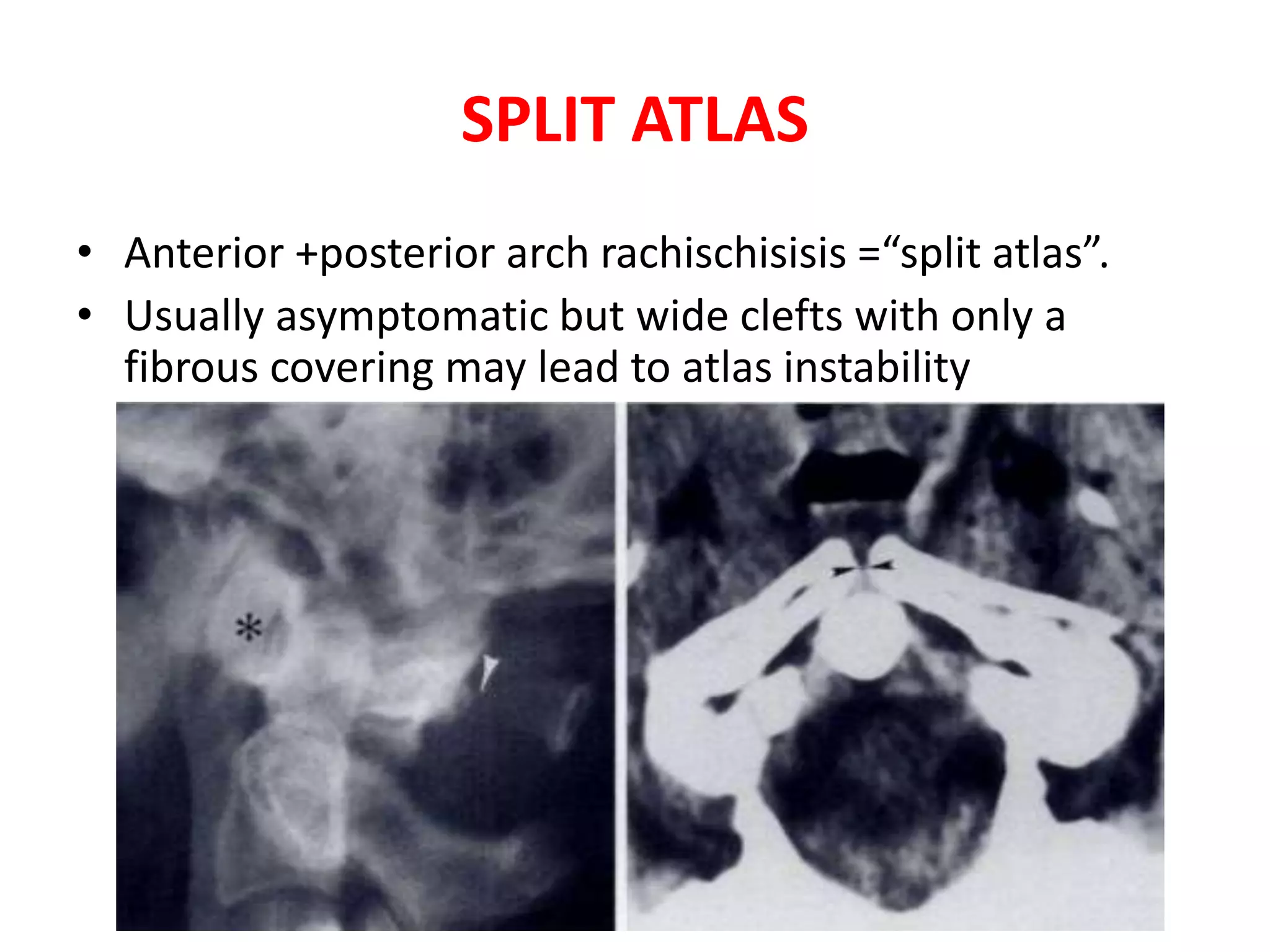 Craniovertebral junction | PPTX