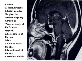 1.Nasion
2.Tuberculum sella
3.Basion (anterior
Margin of the
Foramen magnum)
4. Opisthion
(Posterior margin of
The foramen
Magnum)
5. Posterior pole of
The hard
Palate
6. Anterior arch of
The atlas
7. Posterior arch of
The atlas
8. Odontoid process
 
