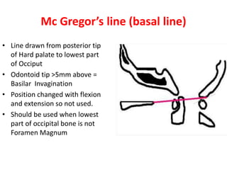 Mc Gregor’s line (basal line)
• Line drawn from posterior tip
of Hard palate to lowest part
of Occiput
• Odontoid tip >5mm above =
Basilar Invagination
• Position changed with flexion
and extension so not used.
• Should be used when lowest
part of occipital bone is not
Foramen Magnum
 