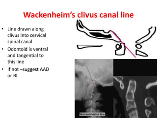 Wackenheim’s clivus canal line
• Line drawn along
clivus into cervical
spinal canal
• Odontoid is ventral
and tangential to
this line
• If not –suggest AAD
or BI
 
