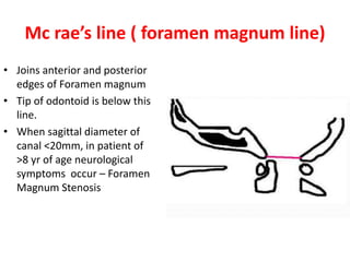 Mc rae’s line ( foramen magnum line)
• Joins anterior and posterior
edges of Foramen magnum
• Tip of odontoid is below this
line.
• When sagittal diameter of
canal <20mm, in patient of
>8 yr of age neurological
symptoms occur – Foramen
Magnum Stenosis
 