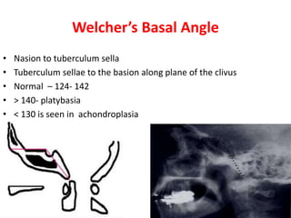 Welcher’s Basal Angle
• Nasion to tuberculum sella
• Tuberculum sellae to the basion along plane of the clivus
• Normal – 124- 142
• > 140- platybasia
• < 130 is seen in achondroplasia
 
