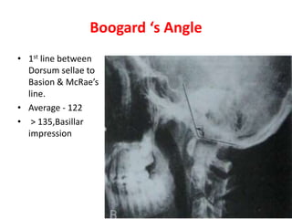 Boogard ‘s Angle
• 1st line between
Dorsum sellae to
Basion & McRae’s
line.
• Average - 122
• > 135,Basillar
impression
 