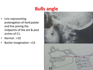 Bulls angle
• Line representing
prolongation of hard palate
and line joining the
midpoints of the ant & post
arches of C1.
• Normal : <10
• Basilar invagination ->13
 